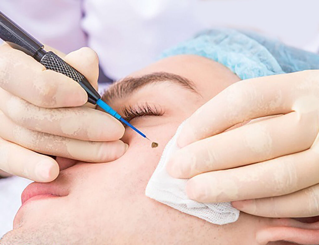 برداشتن خال با لیزر