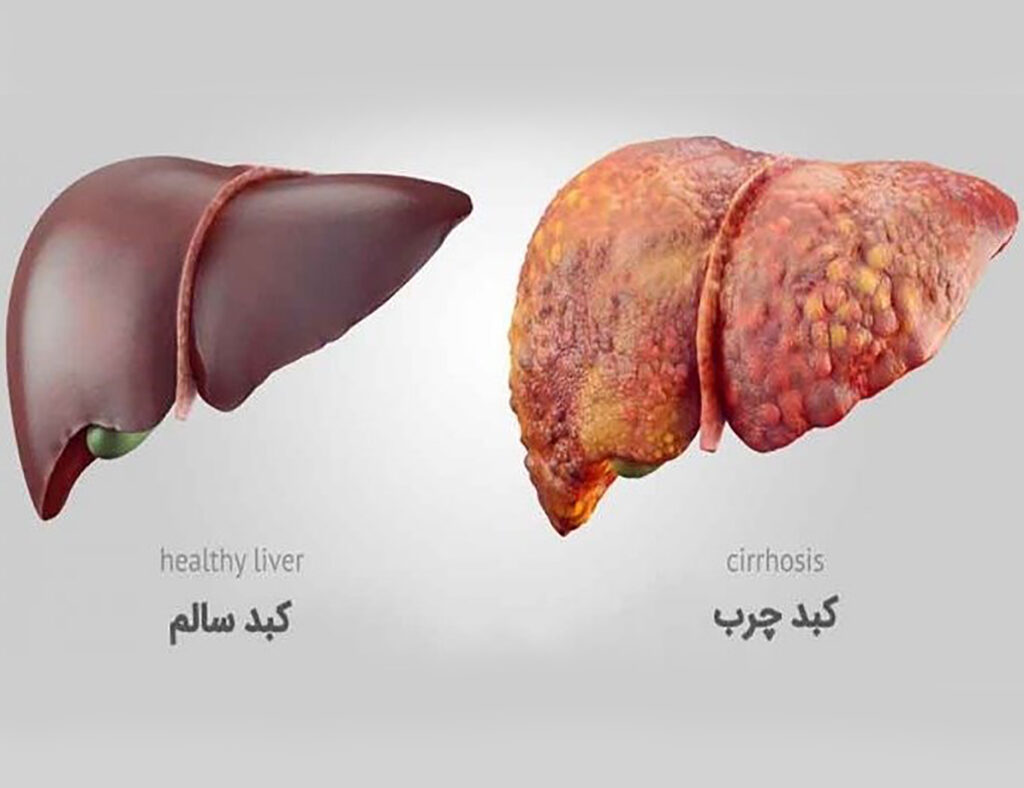 کبد چرب و راه های تشخیص و پیشگیری