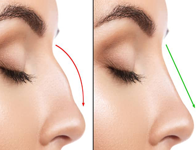 تفاوت سپتوپلاستی و رینوپلاستی