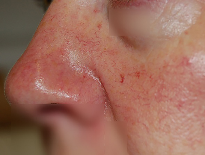 مشکل پوست بعد از عمل بینی