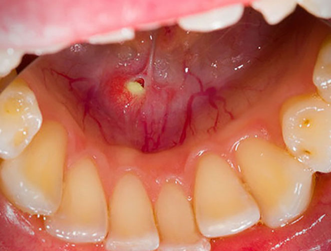 درمان سنگ غدد بزاقی در طب سنتی