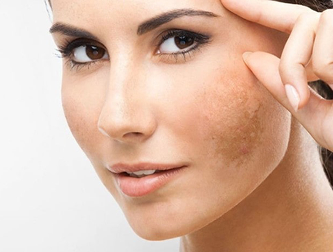 انواع لک پوستی