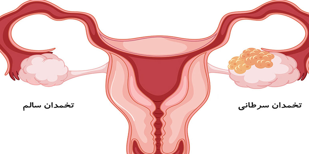 علائم سرطان تخمدان