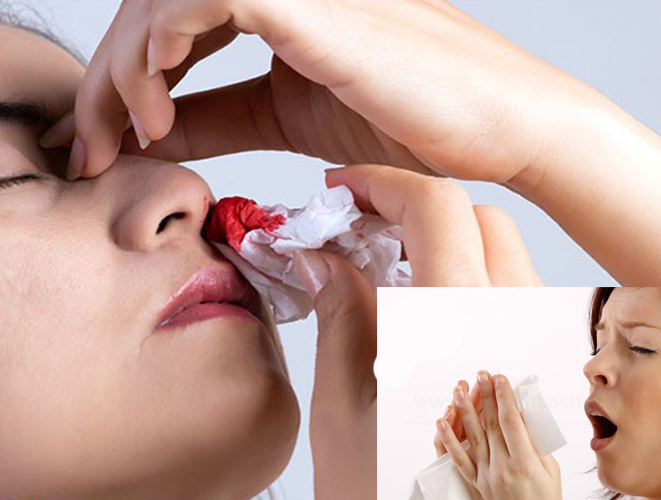 عوارض عطسه و سرفه بعد از جراحی بینی