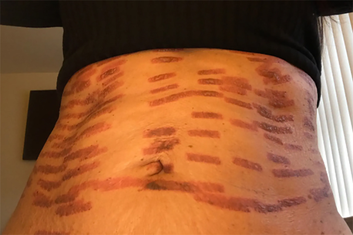 درمان سوختگی ناشی از لیزر