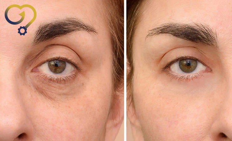 تزریق فیلر چشم