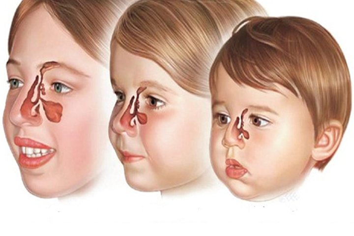 پولیپ بینی کودکان