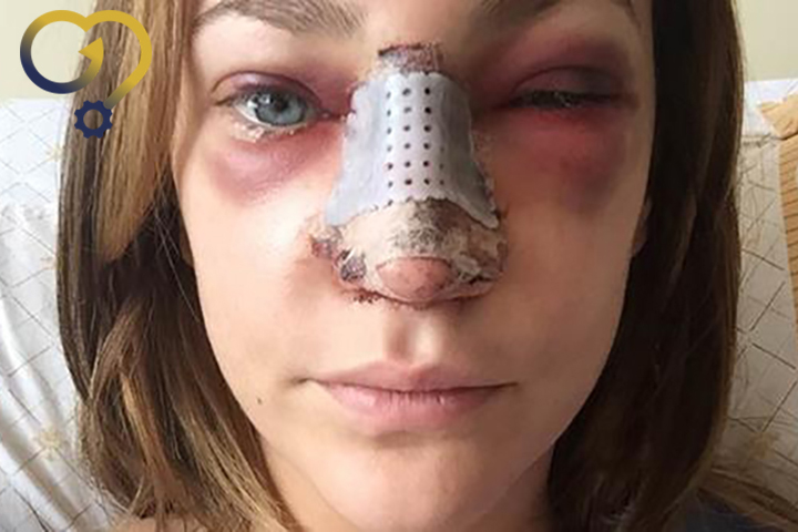 دلایل کبودی و ورم چشم بعد از عمل بینی