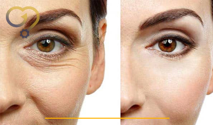 هایفوتراپی دور چشم