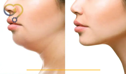 هایفوتراپی غبغب