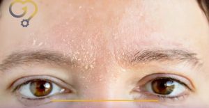 نشانه خشکی پوست