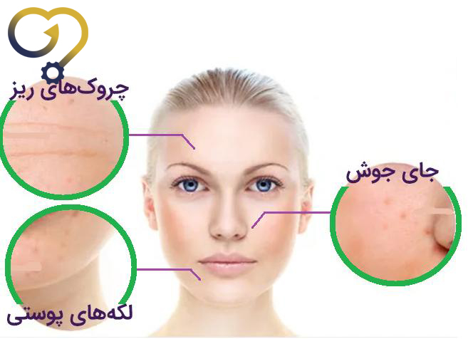 کاربرد و مزایای مزونیدلینگ