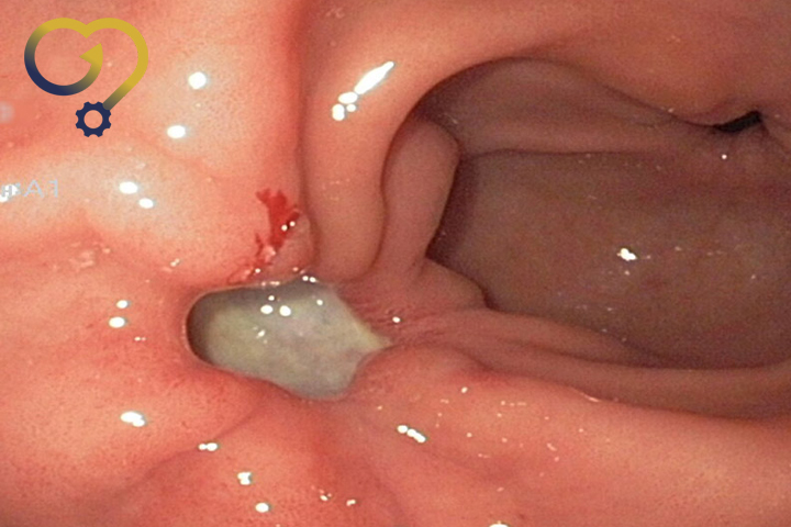 درمان زخم معده