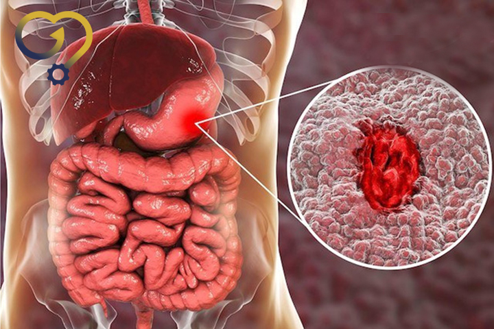 علائم زخم معده
