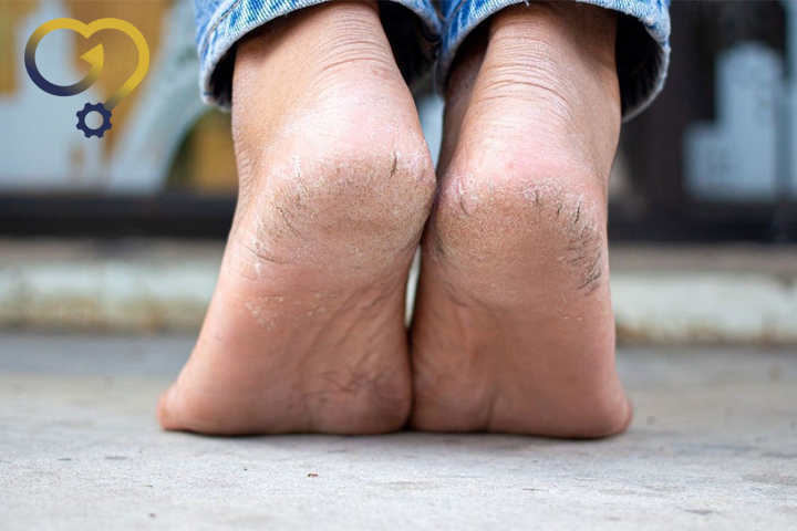 ترک پاشنه پا