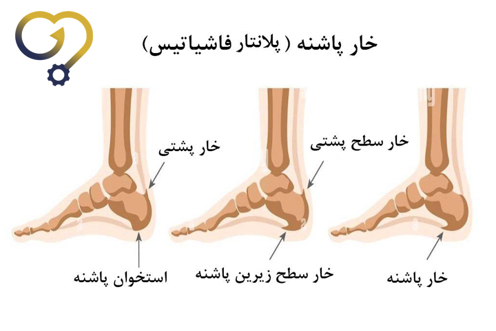 علل ایجاد خار پاشنه